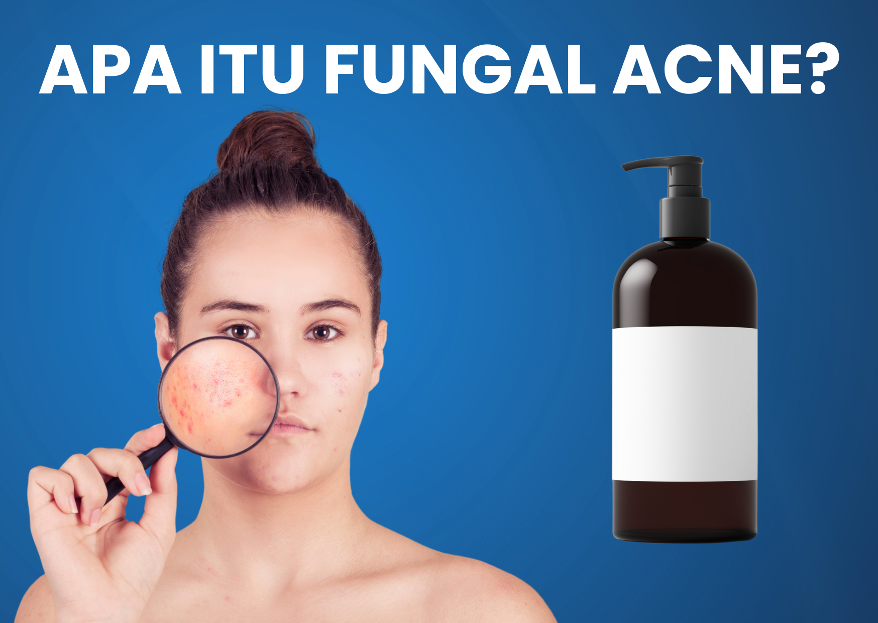 Apa Itu Fungal Acne? Dan Kenapa Skincare Biasa Nggak Ampuh?
